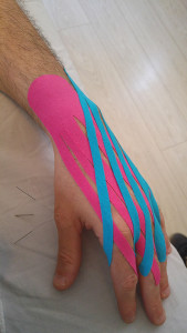 קינזיוטייפינג בניקוז לימפטי לטיפול בנפיחות ודלקת בכף היד