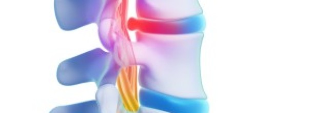 פריצת דיסק, דיקור סיני לפריצת דיסק