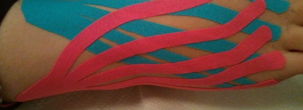 קינזיוטייפינג דלקת בקרסול