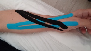 קינזיוטייפינג לדלקת במפרק האגודל